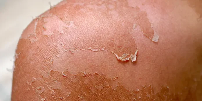 How to Treat Sunburn Peeling Skin